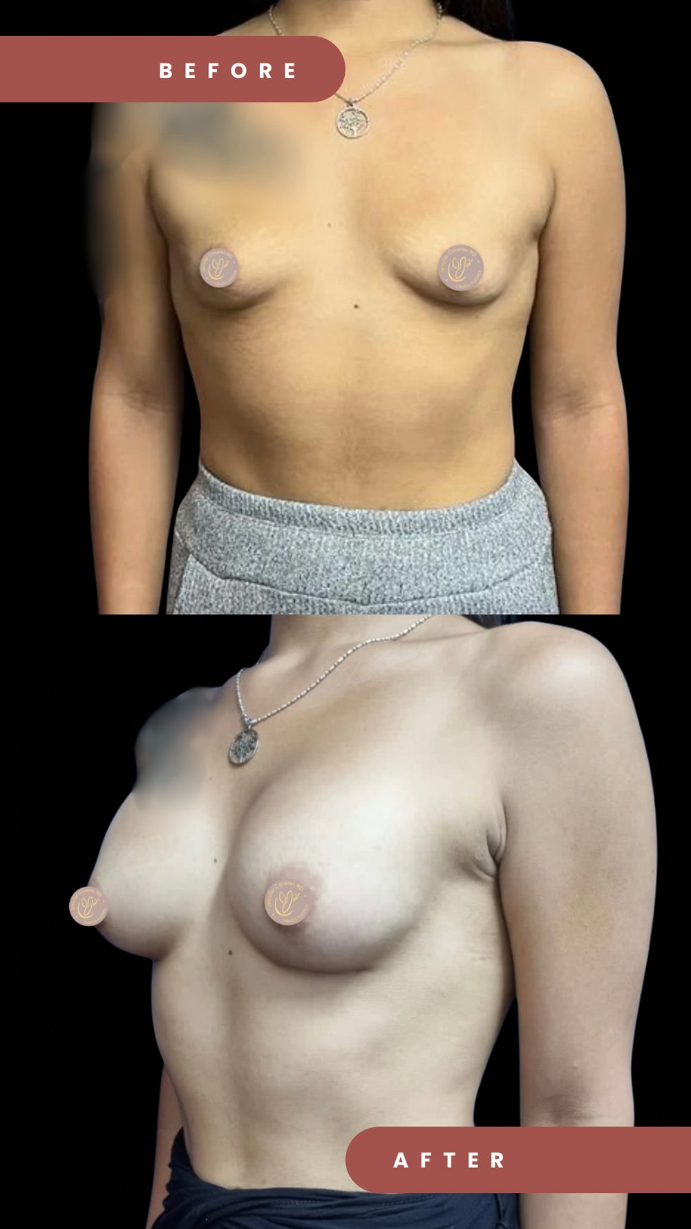 Antes y después de aumento mamario con implantes — Dra. Jennifer Cáceres, Olivos, Buenos Aires