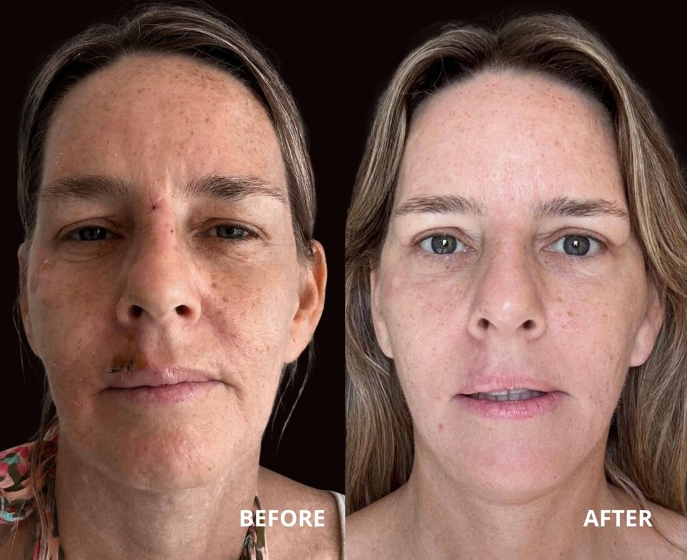 Antes y después de lifting facial — Dra. Jennifer Cáceres, Olivos