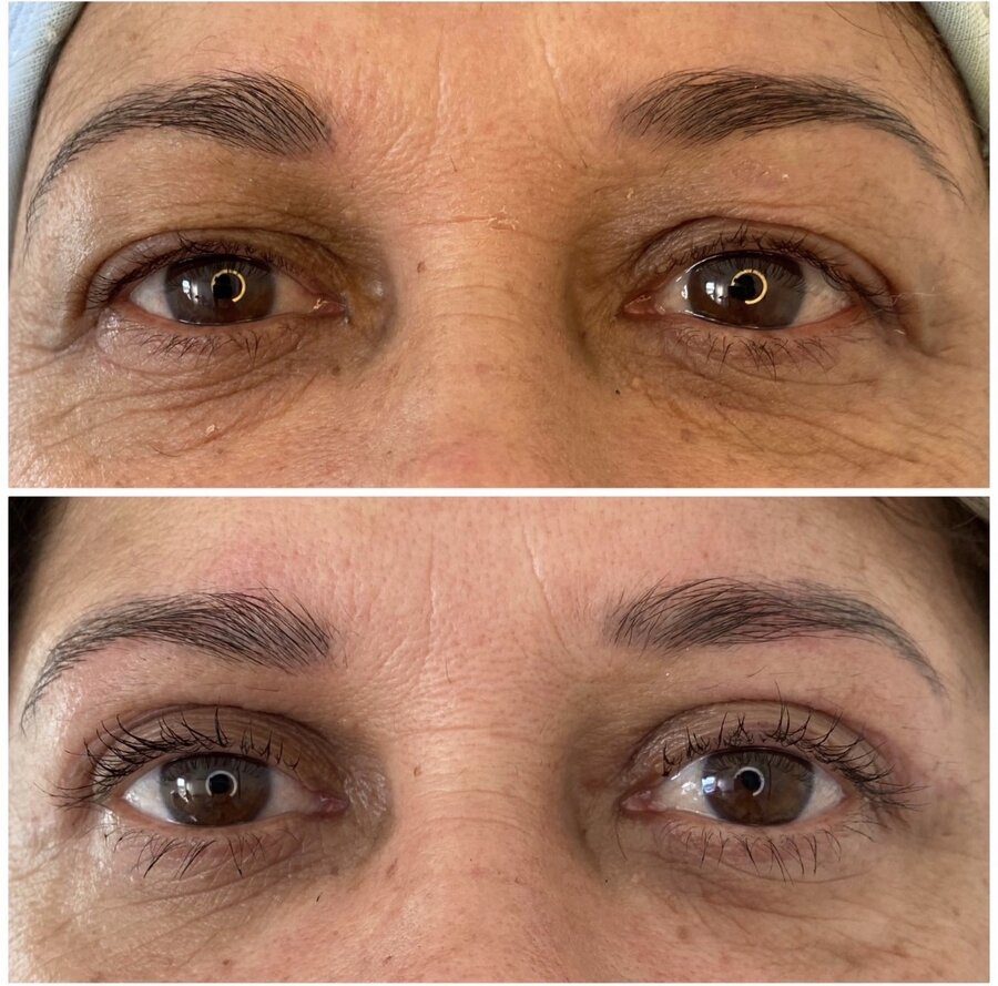 Detalle de mirada antes y después de blefaroplastia