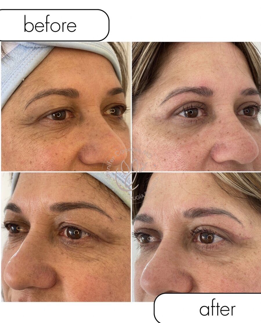 Antes y después de blefaroplastia, vistas de frente y perfil