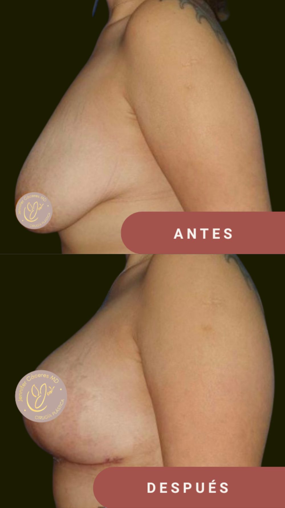 Antes y después de mastopexia, vista de perfil