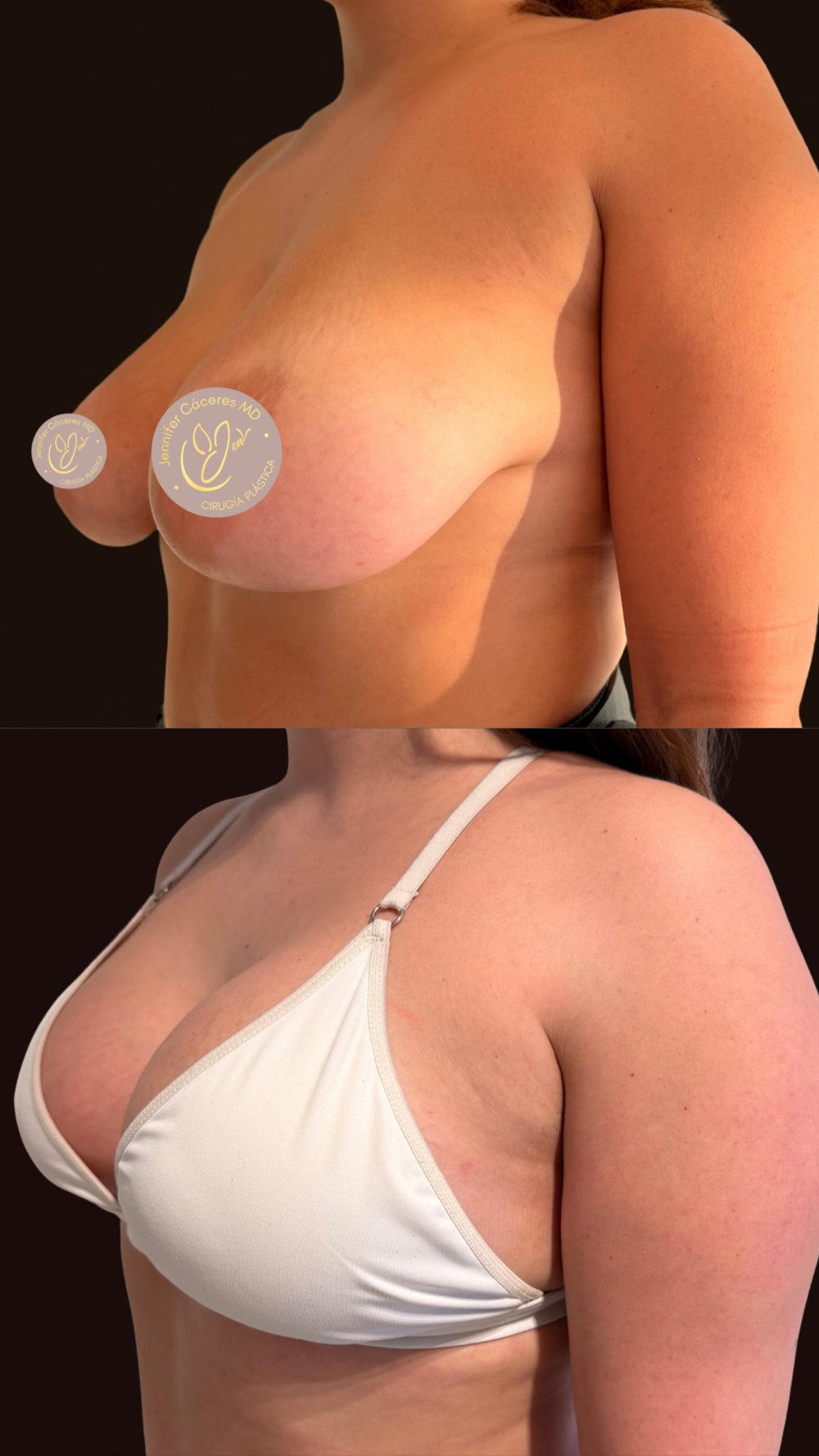 Antes y después de mastopexia con implantes — Dra. Jennifer Cáceres