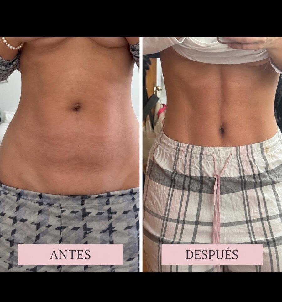Antes y después de abdominoplastia, foto enviada por la paciente — Dra. Jennifer Cáceres, Olivos