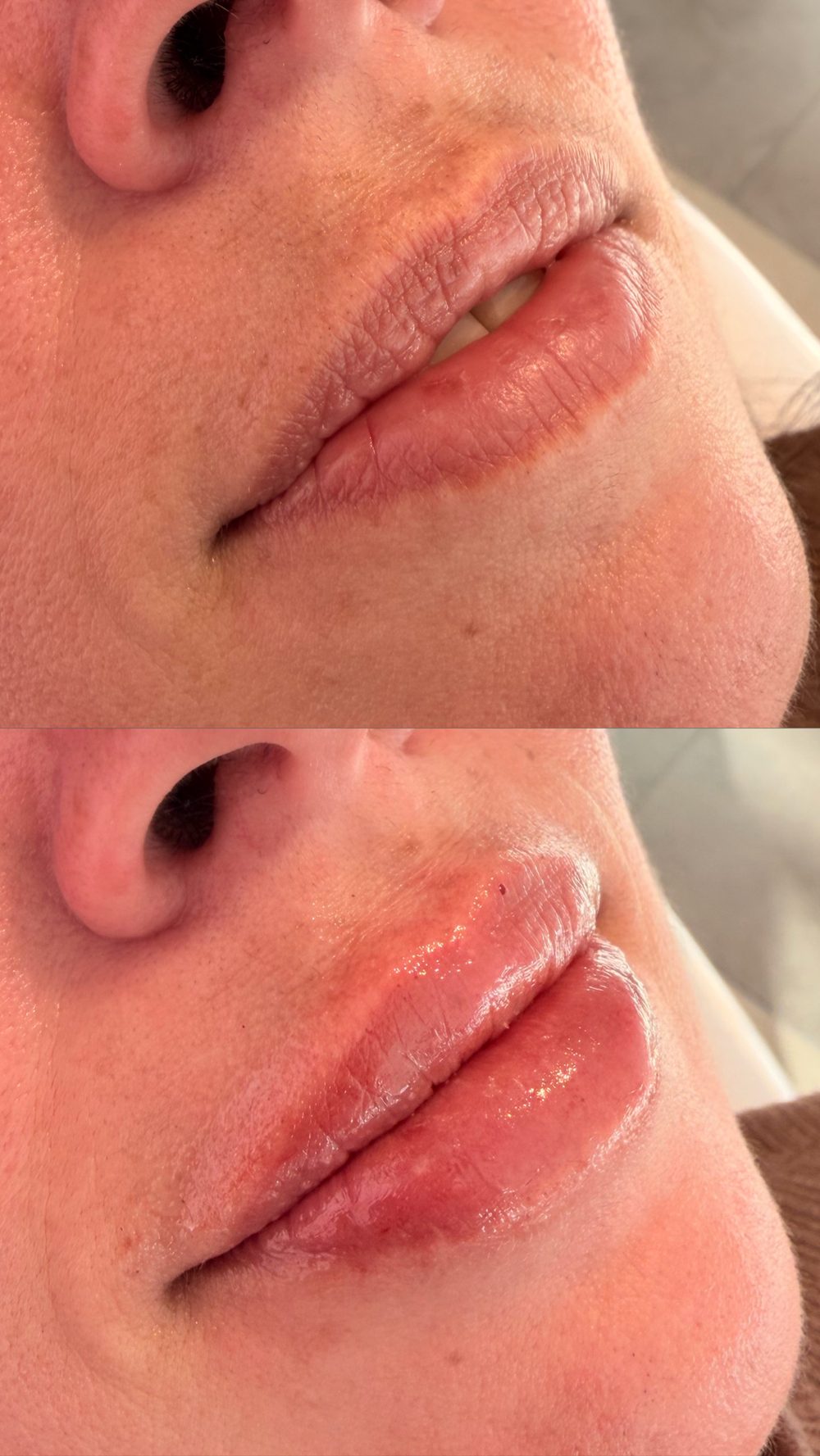 Antes y después de relleno labial con ácido hialurónico — Dra. Jennifer Cáceres